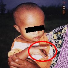 malformation in fingers
